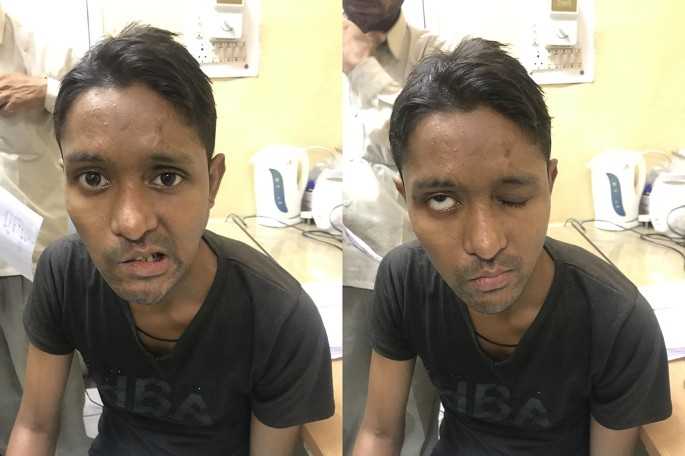 Facial Palsy Treatment At Home BD